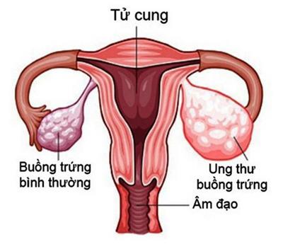 Sau khi tôi điều trị ung thư bị cắt 2 bên buồng trứng thì tôi còn có thể có con được không?