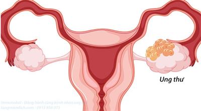 Cắt bỏ 2 bên buồng trứng sau điều trị ung thư có còn tái phát không?